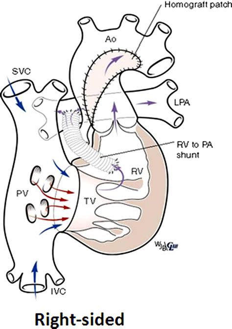 rv-pa conduit